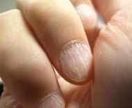 Бугристые ногти – причины и лечение